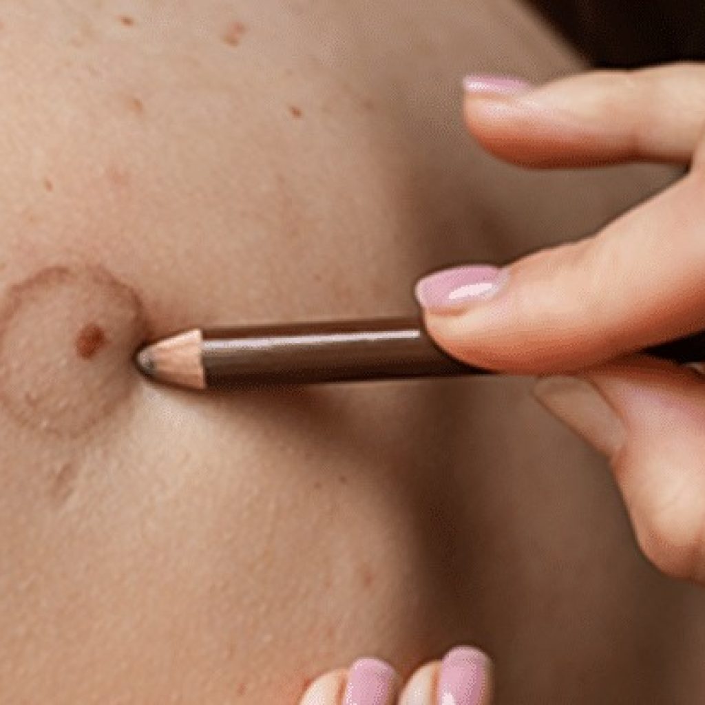 Discreet scar concealment solutions in Dubai