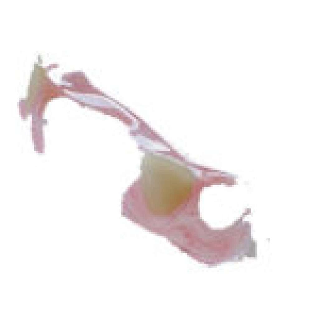 Swift denture fixes for urgent Brisbane needs