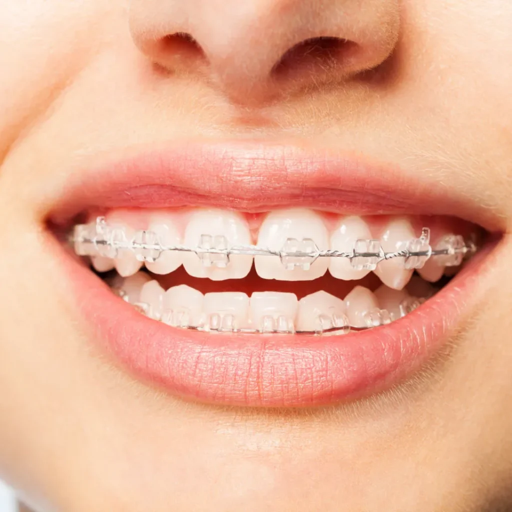 Understanding Typical Prices for Orthodontic Braces in the UK