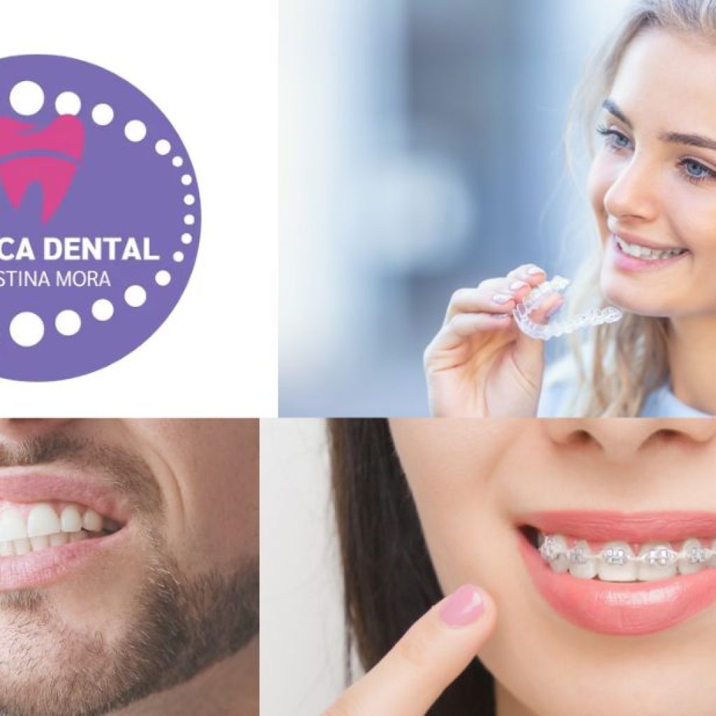 Sorris complet amb implants a Gines: solucions duradores i estètiques