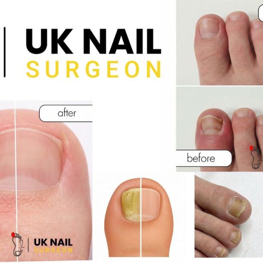 Relieve Ingrown Toenails: Practical Treatments and Aftercare Relieve Ingrown Toenails: Practical Treatments and Aftercare