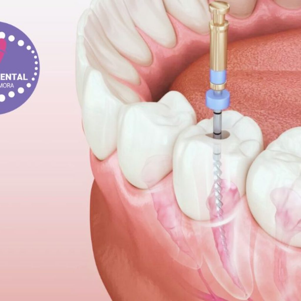 Pròtesis Dental a Gines: solucions naturals i duradores per al teu somriure