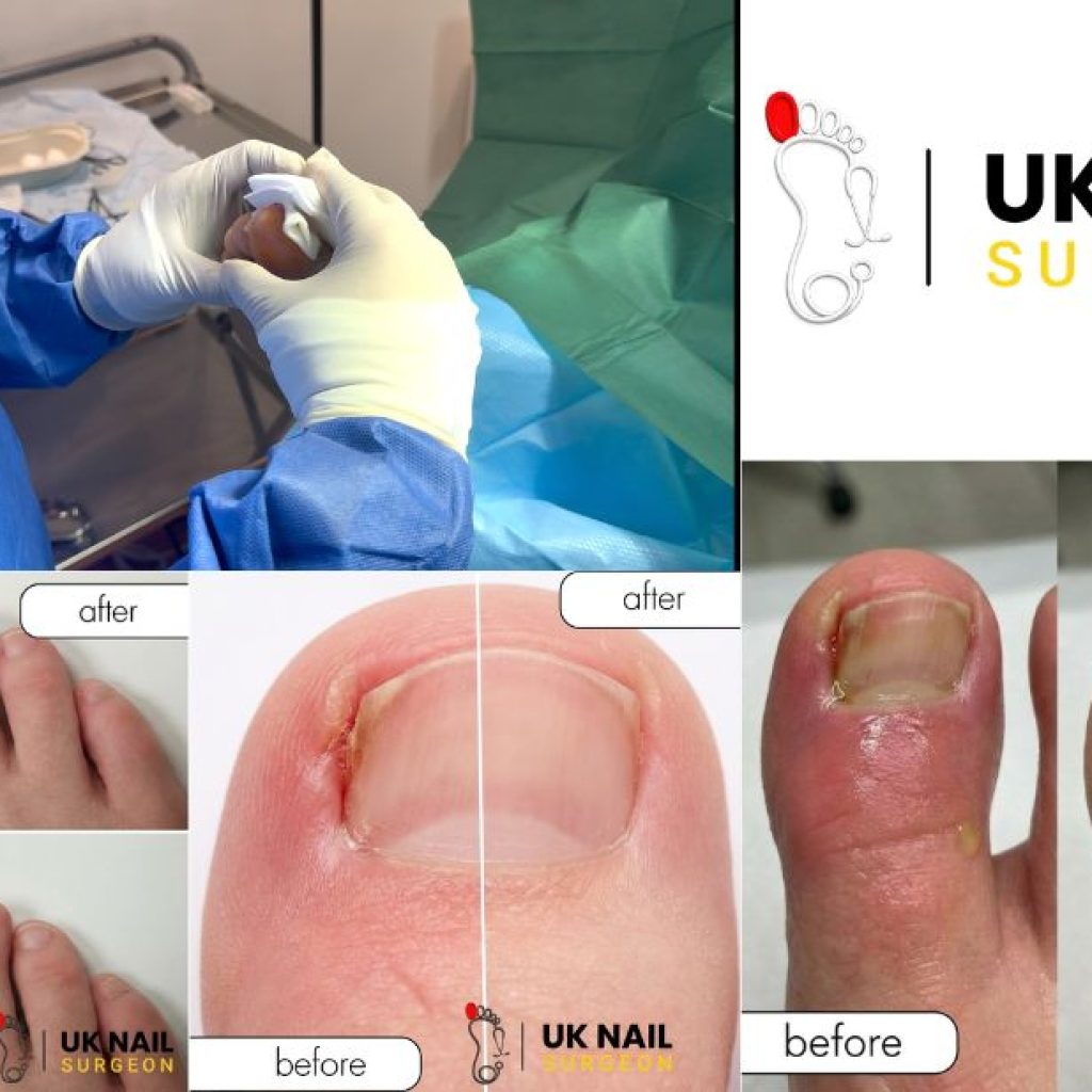 Relieve Toe Pain: Safe, Local Anaesthetic Nail Procedures in the UK
