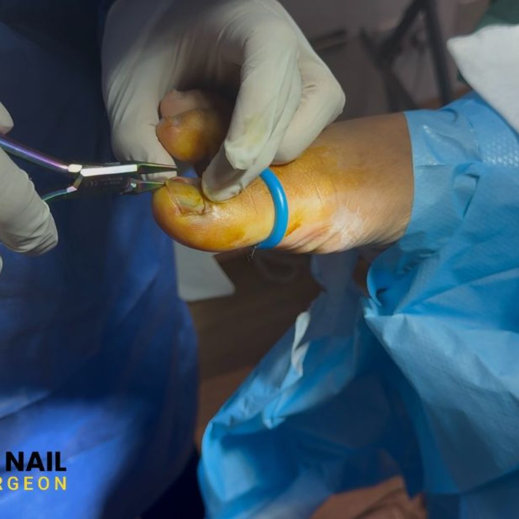 Relief for Painful Toenails: Safe, Expert Care and Aftercare