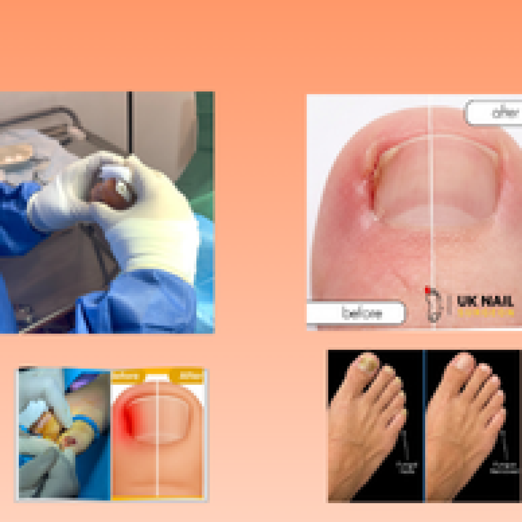 Relieve toe pain with expert ingrown nail care and swift relief
