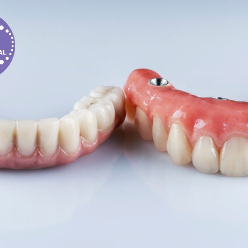 Recerca d’un somriure estable a Gines amb experts en implants