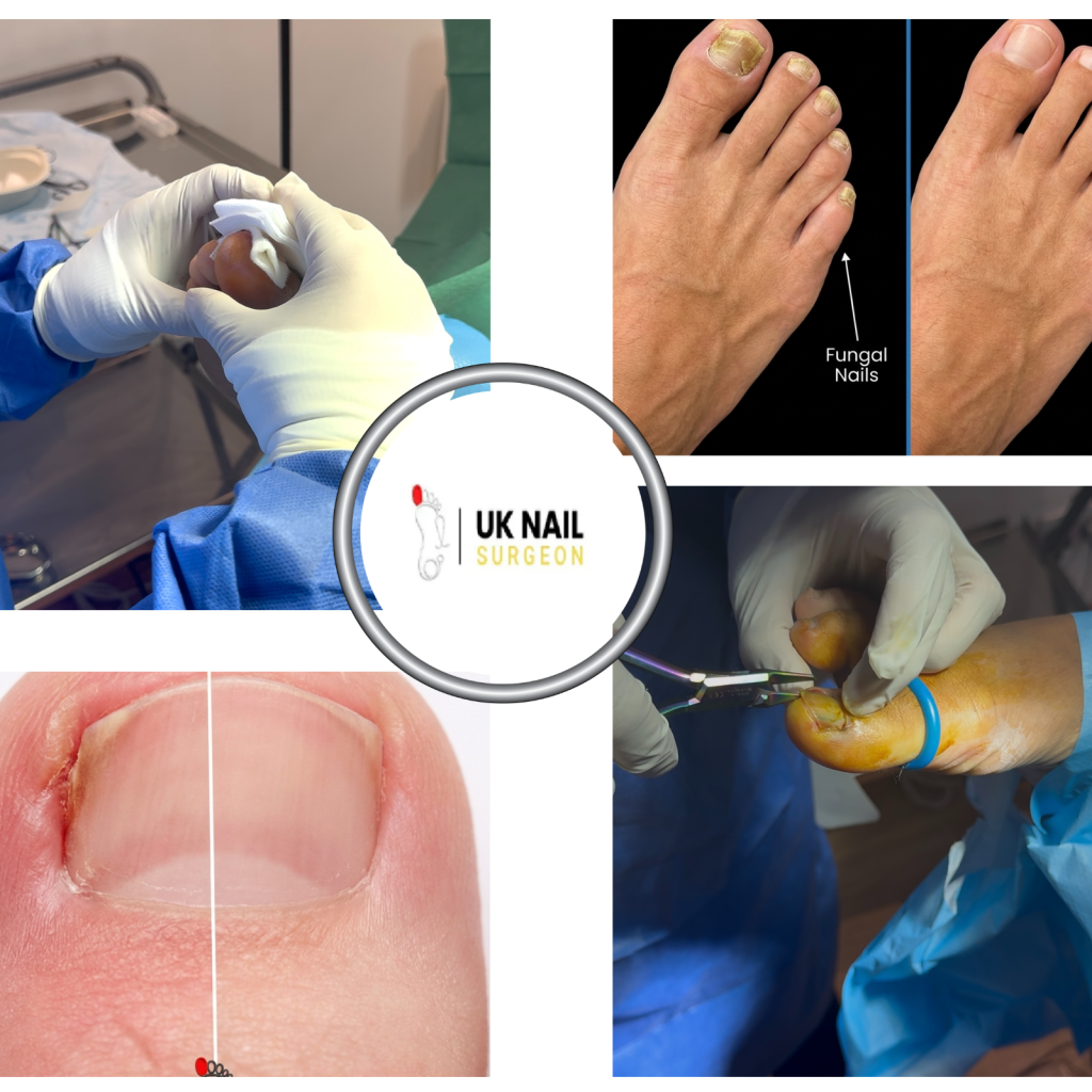 Relieve toe pain with expert ingrown nail care